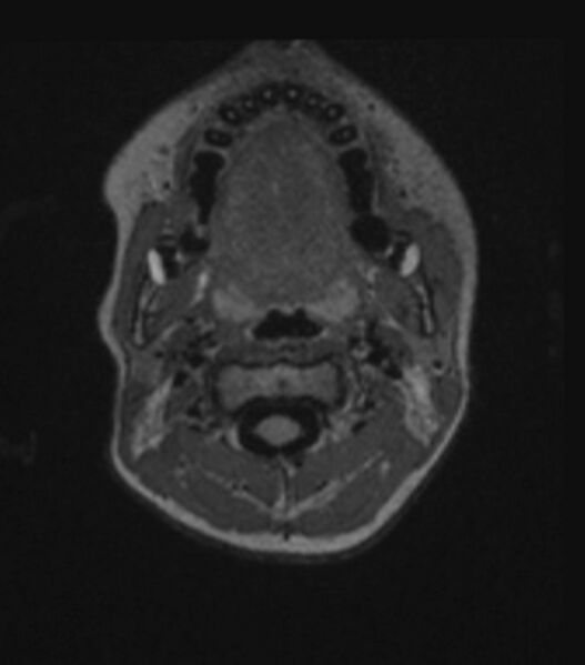 File:Choroid plexus carcinoma (Radiopaedia 91013-108553 Axial FLAIR C+ 46).jpg