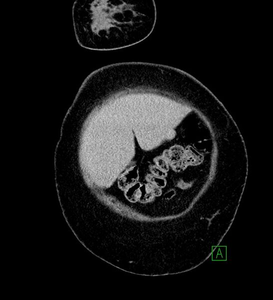 File:Chromophobe renal cell carcinoma (Radiopaedia 84239-99519 F 10).jpg