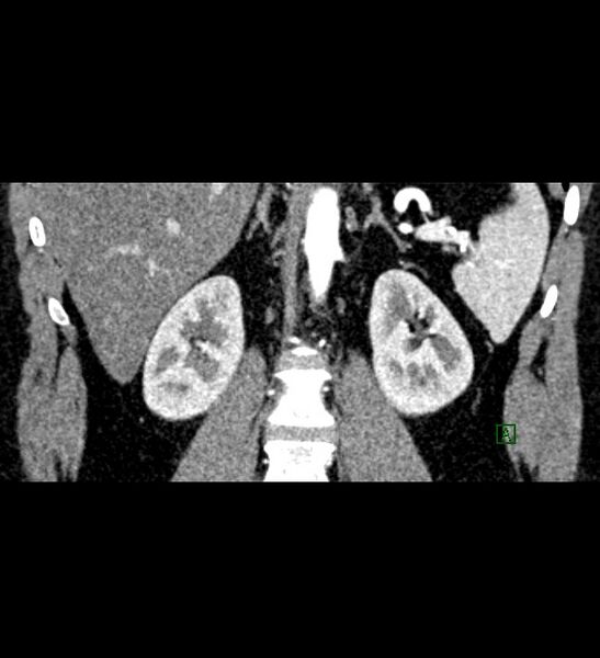 File:Chromophobe renal cell carcinoma (Radiopaedia 84286-99573 E 55).jpg