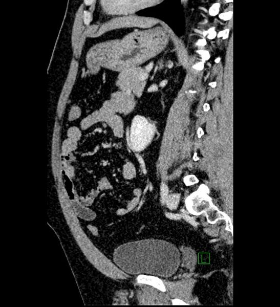 File:Chromophobe renal cell carcinoma (Radiopaedia 84286-99573 I 72).jpg