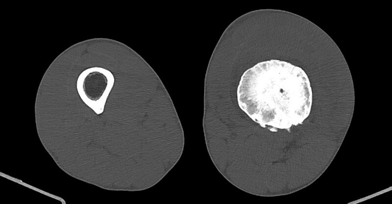 File:Chronic osteomyelitis (with sequestrum) (Radiopaedia 74813-85822 Axial non-contrast 127).jpg