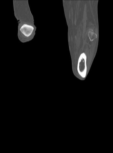 File:Chronic osteomyelitis - tibia (with sequestrum) (Radiopaedia 73273-84090 Coronal non-contrast 64).jpg