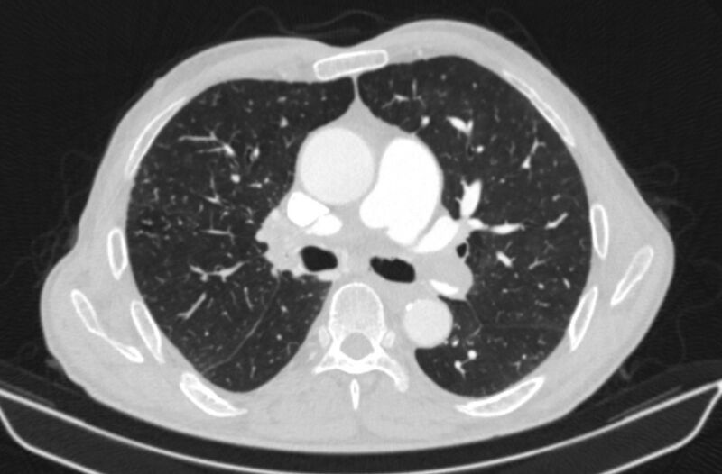File:Chronic pulmonary embolism (Radiopaedia 91241-108843 Axial lung window 40).jpg
