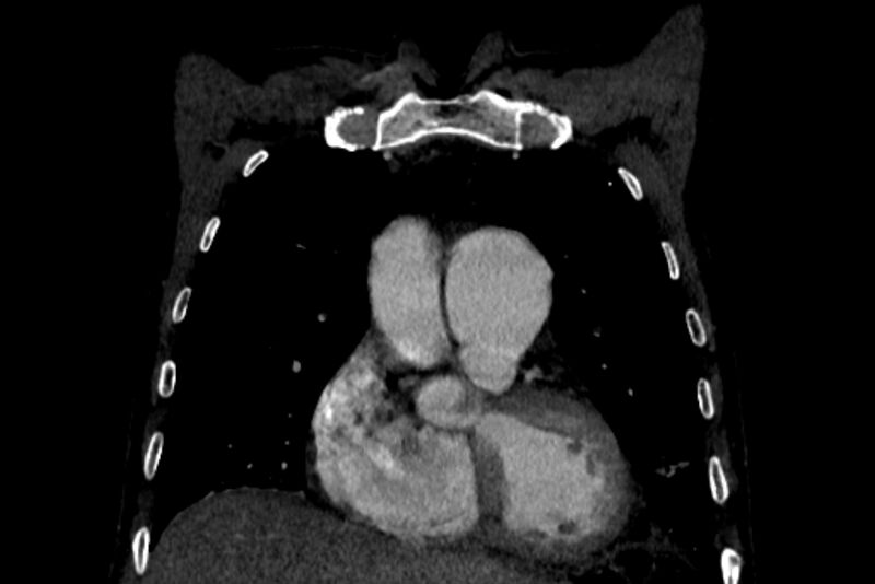 File:Chronic pulmonary embolism with bubbly consolidation (Radiopaedia 91248-108850 B 40).jpg