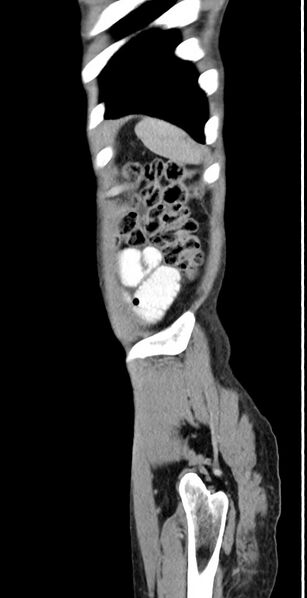 File:Chronic small bowel volvulus (Radiopaedia 75224-86322 C 20).jpg