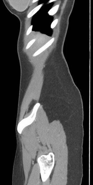 File:Circumaortic left renal vein with a duplicated retroaortic vein (Radiopaedia 91668-109398 C 118).jpg