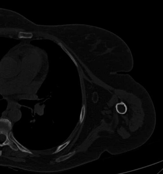 File:Clear cell chondrosarcoma - humerus (Radiopaedia 63104-71612 Axial bone window 82).jpg