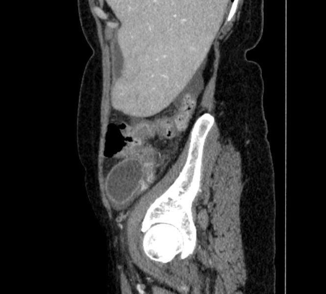 File:Closed loop small bowel obstruction (Radiopaedia 71211-81508 C 10).jpg