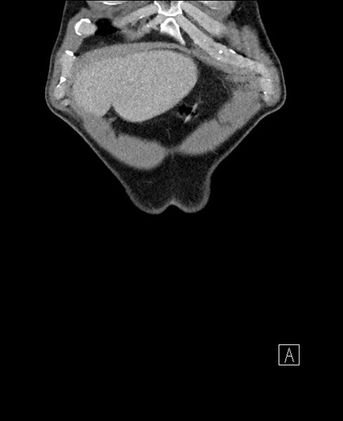 File:Closed loop small bowel obstruction - internal hernia (Radiopaedia 57806-64778 A 8).jpg