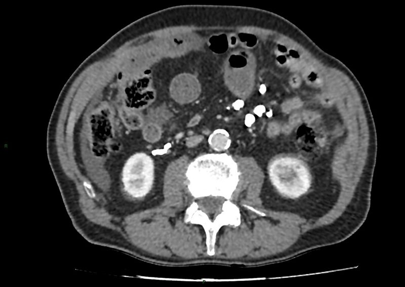 File:Closed loop small bowel obstruction with ischemia (Radiopaedia 84180-99456 A 57).jpg
