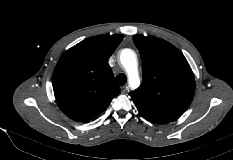 File:Coarctation of aorta with aortic valve stenosis (Radiopaedia 70463-80574 A 41).jpg