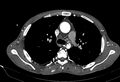 Coarctation of aorta with aortic valve stenosis (Radiopaedia 70463-80574 A 58).jpg