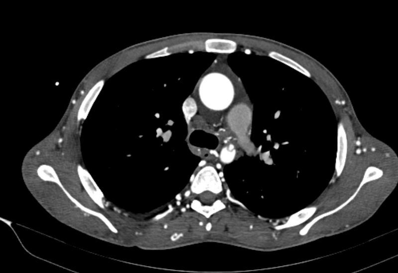 File:Coarctation of aorta with aortic valve stenosis (Radiopaedia 70463-80574 A 58).jpg
