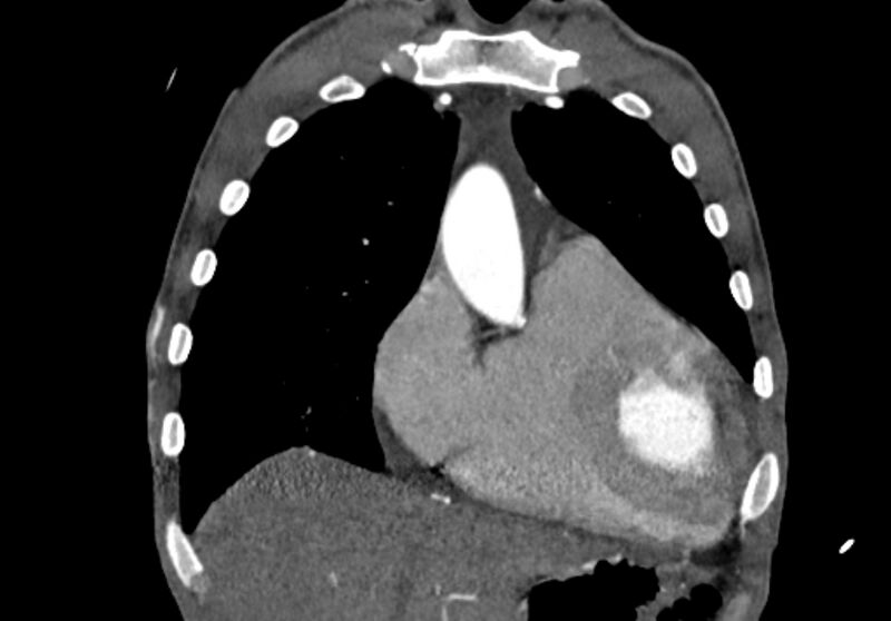 File:Coarctation of aorta with aortic valve stenosis (Radiopaedia 70463-80574 C 44).jpg