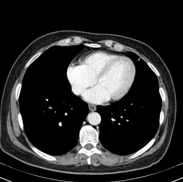 File:Colon carcinoma with hepatic metastases (Radiopaedia 29477-29961 A 1).jpg