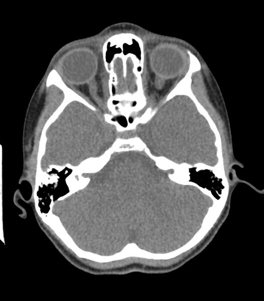 File:Nasoorbitoethmoid fracture (Radiopaedia 90044-107205 Axial 133).jpg