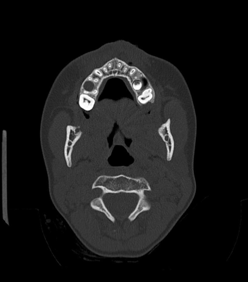 Nasoorbitoethmoid fracture (Radiopaedia 90044-107205 Axial bone window 46).jpg