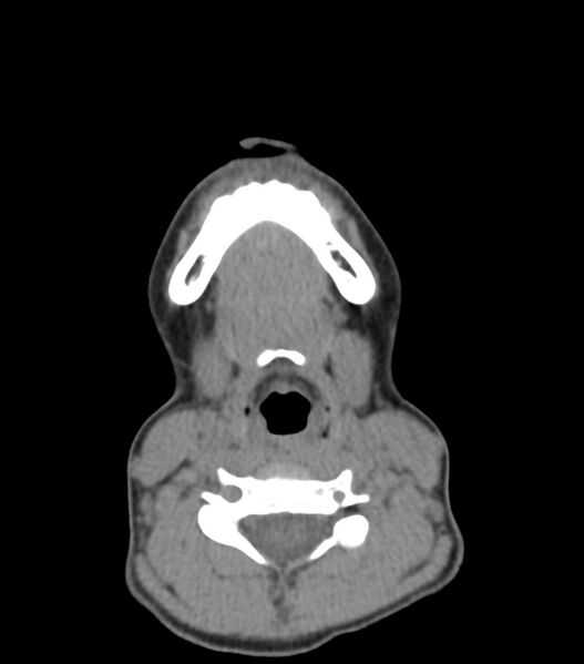 File:Nasoorbitoethmoid fracture (Radiopaedia 90044-107205 Axial non-contrast 40).jpg