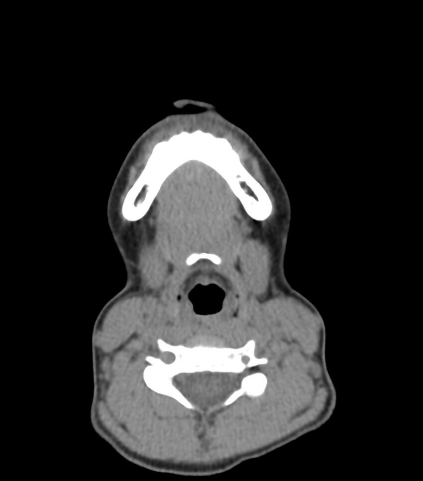 Nasoorbitoethmoid fracture (Radiopaedia 90044-107205 Axial non-contrast 40).jpg