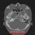 Nasopharyngeal carcinoma recurrence - skull base destruction (Radiopaedia 29107-29490 Axial bone window 85).jpg