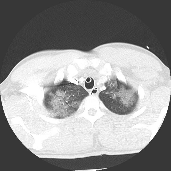 File:Near drowning pulmonary edema (Radiopaedia 16868-16591 Axial lung window 1).jpg
