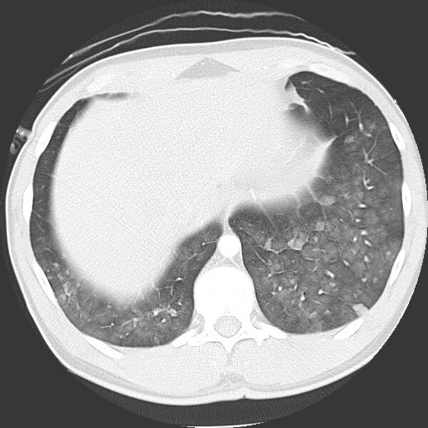 File:Near drowning pulmonary edema (Radiopaedia 16868-16591 Axial lung window 46).jpg