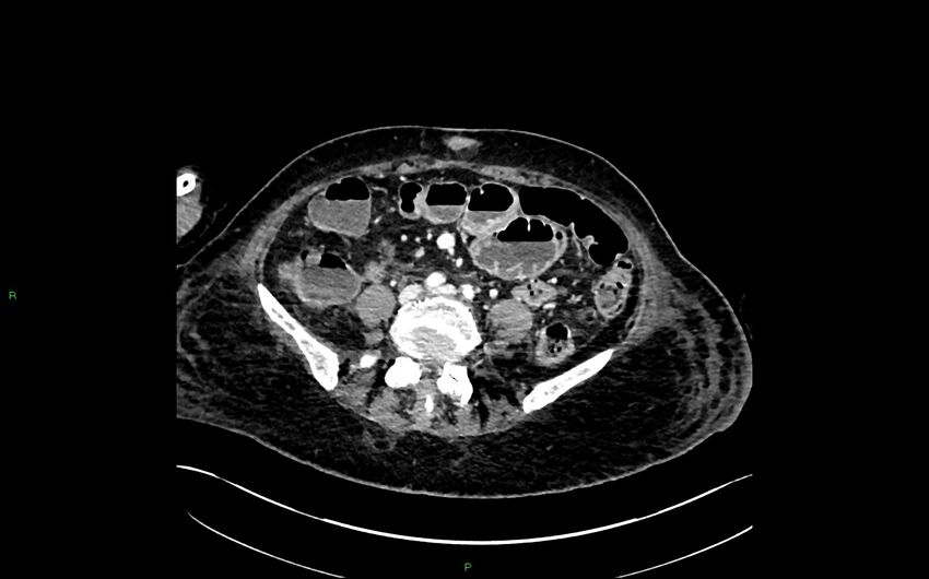 Neo-terminal ileal stricture (Crohn disease) (Radiopaedia 33790-34948 A 283).jpg