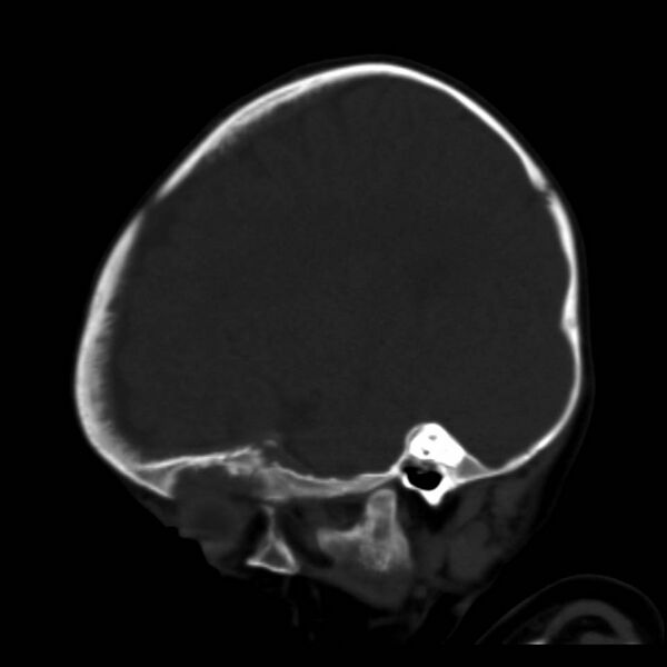 File:Neuroblastoma with skull metastases (Radiopaedia 30326-30958 Sagittal bone window 31).jpg