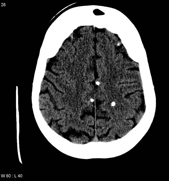 File:Neurocysticercosis (Radiopaedia 7773-8596 non-contrast 12).jpg