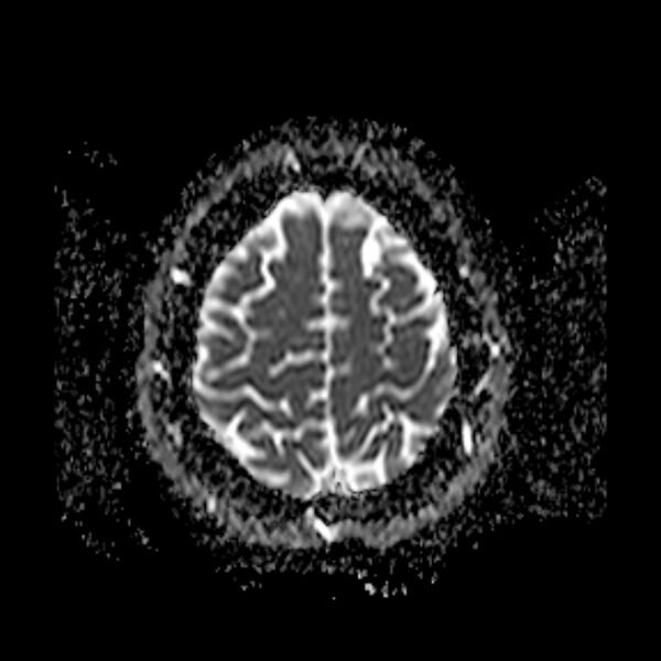 File:Neurofibromatosis type 2 (Radiopaedia 67470-76871 Axial ADC 20).jpg