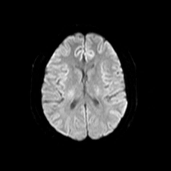 File:Neurofibromatosis type 2 (Radiopaedia 67470-76871 Axial DWI 12).jpg