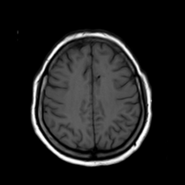 File:Neurofibromatosis type 2 (Radiopaedia 67470-76871 Axial T1 17).jpg