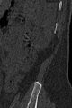 Normal CT lumbar spine (Radiopaedia 53981-60118 Sagittal bone window 104).jpg