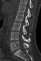 Normal CT lumbar spine (Radiopaedia 53981-60118 Sagittal bone window 44).jpg