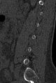 Normal CT lumbar spine (Radiopaedia 53981-60118 Sagittal bone window 72).jpg