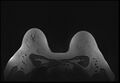 Normal breast MRI - dense breasts (Radiopaedia 80454-93850 Axial T1 179).jpg