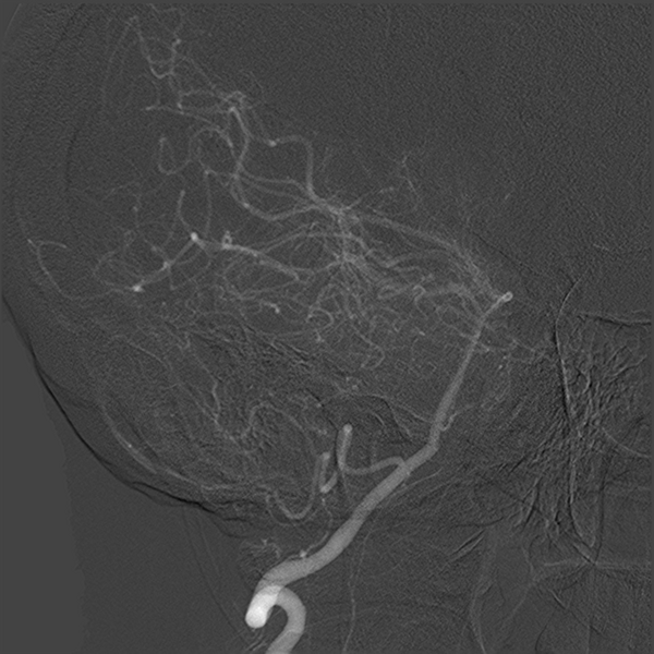 File:Normal cerebral angiogram (four vessel DSA) (Radiopaedia 41708-44649 O 9).png