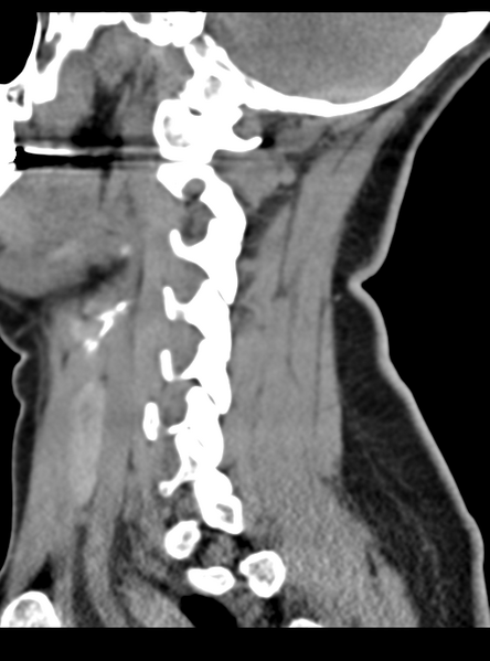 File:Normal cervical spine MRI (including Dixon) (Radiopaedia 42762-45926 C 18).png