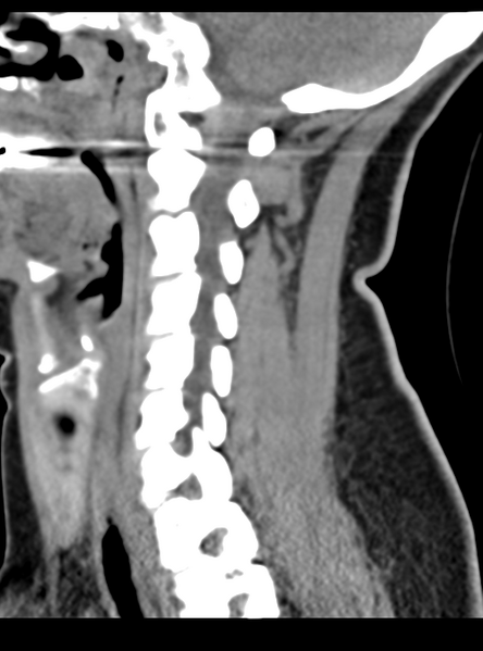 File:Normal cervical spine MRI (including Dixon) (Radiopaedia 42762-45926 C 24).png