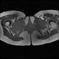 Normal female pelvis MRI (retroverted uterus) (Radiopaedia 61832-69933 Axial T1 30).jpg