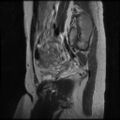 Normal female pelvis MRI (retroverted uterus) (Radiopaedia 61832-69933 Sagittal T2 8).jpg