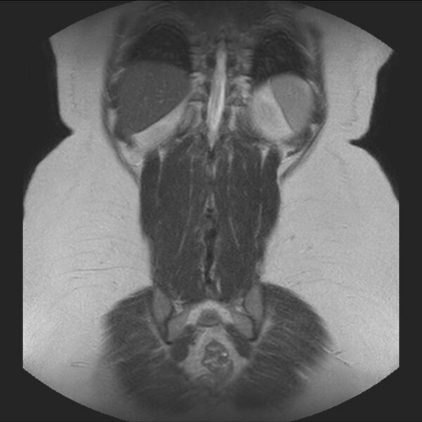 File:Normal liver MRI with Gadolinium (Radiopaedia 58913-66163 Coronal T2 35).jpg