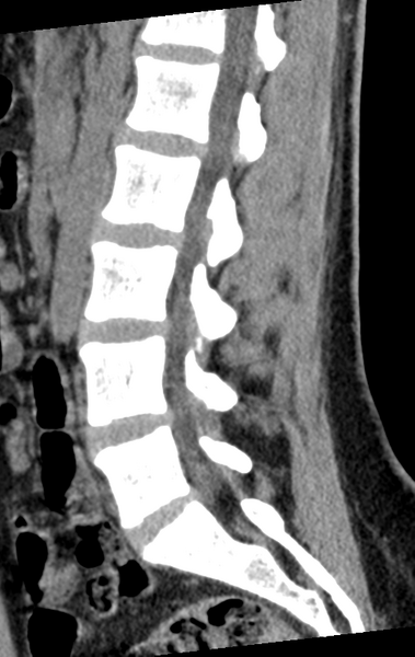 File:Normal lumbar spine CT (Radiopaedia 46533-50986 C 47).png