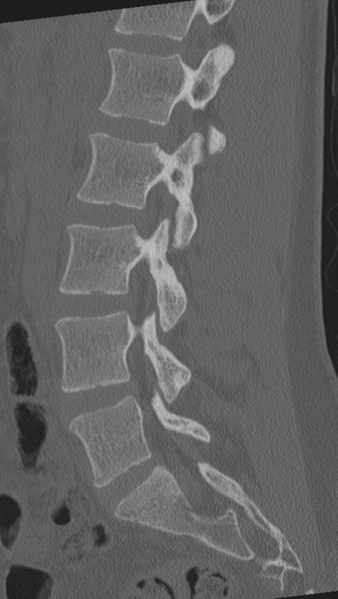 File:Normal lumbar spine CT (Radiopaedia 46533-50986 Sagittal bone window 43).png