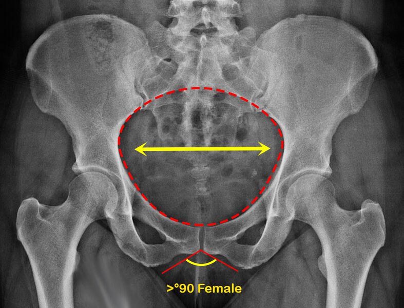 File:Normal pelvis- gender differences (Radiopaedia 43111-46396 Female 1).jpg