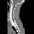 Normal trauma spine imaging (age 16) (Radiopaedia 45335-49358 C 24).jpg