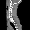 Normal trauma spine imaging (age 16) (Radiopaedia 45335-49358 C 26).jpg