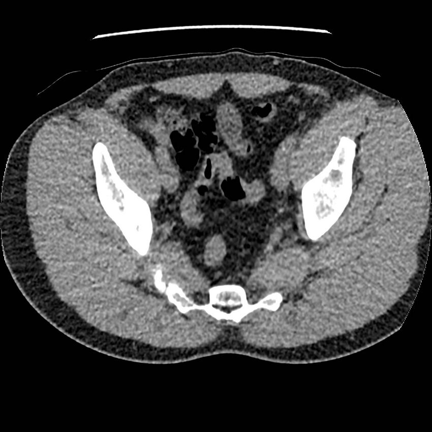 Obstructing ureteric calculus and ureteric anatomy (Radiopaedia 62730-71042 Axial non-contrast 140).jpg