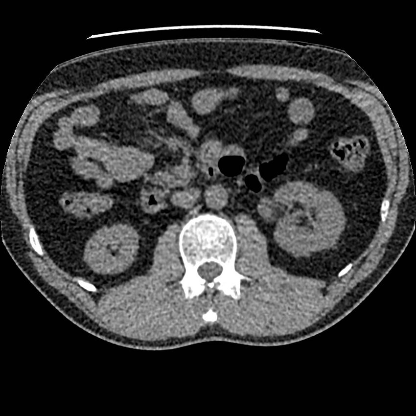 Obstructing ureteric calculus and ureteric anatomy (Radiopaedia 62730-71042 Axial non-contrast 46).jpg