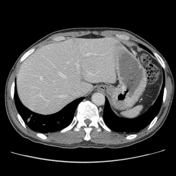 File:Obstructive bladder transitional cell carcinoma (Radiopaedia 9825-10410 A 1).jpg